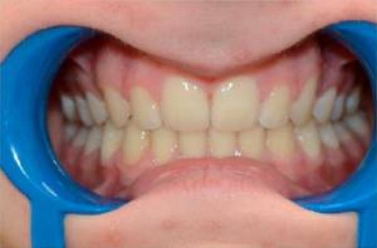 Vue de face des dents alignées après un traitement orthodontique chez le Dr Wees à Caen.