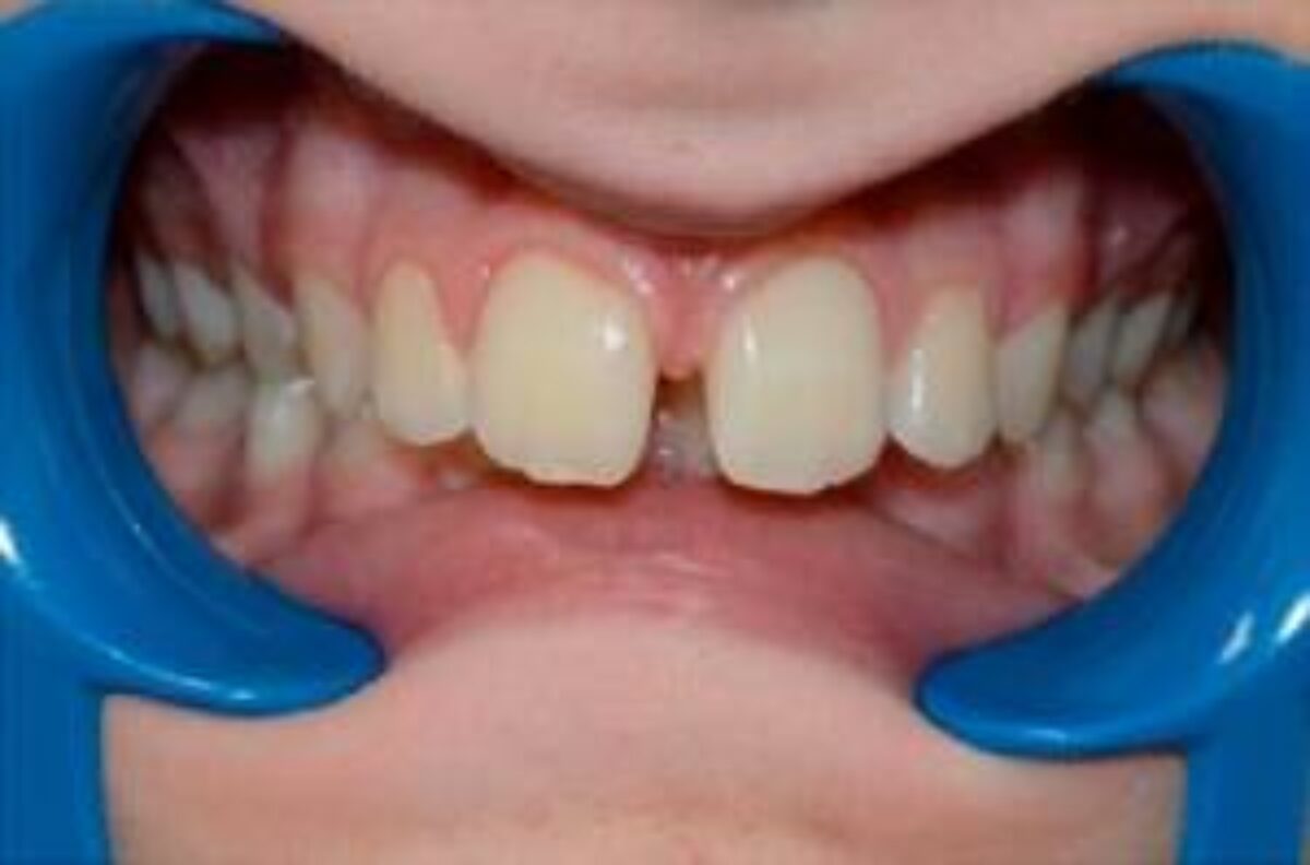 Patient présentant un diastème dentaire avant un traitement orthodontique à Caen.