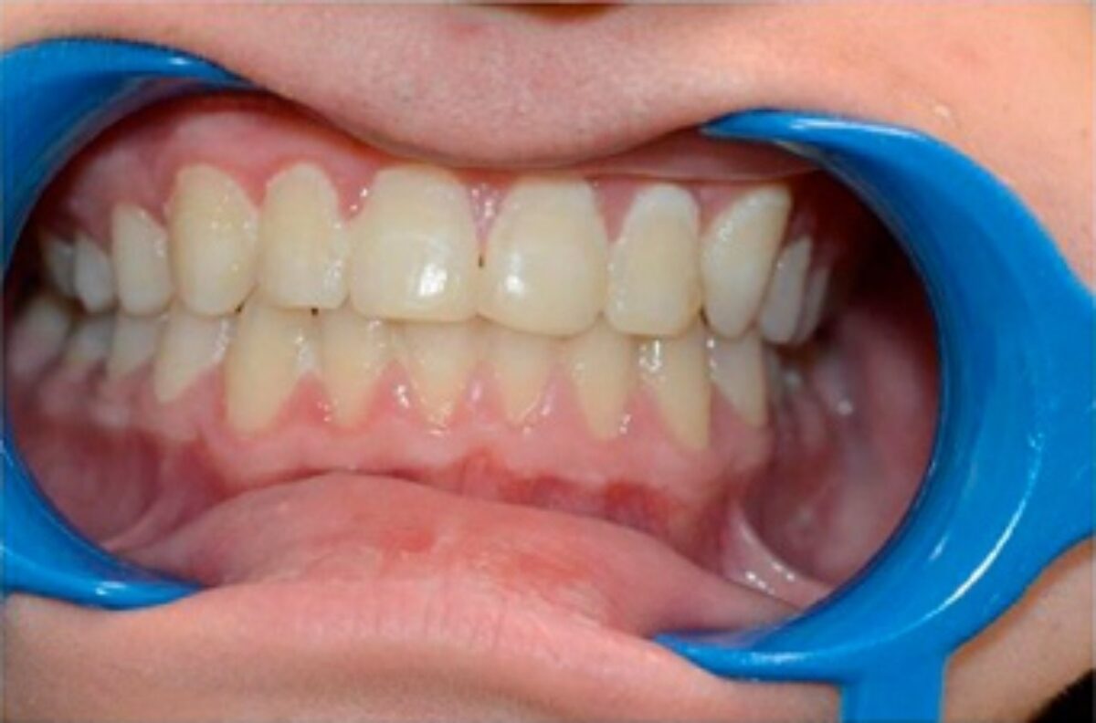 Résultat d'un traitement orthodontique montrant des dents bien alignées.