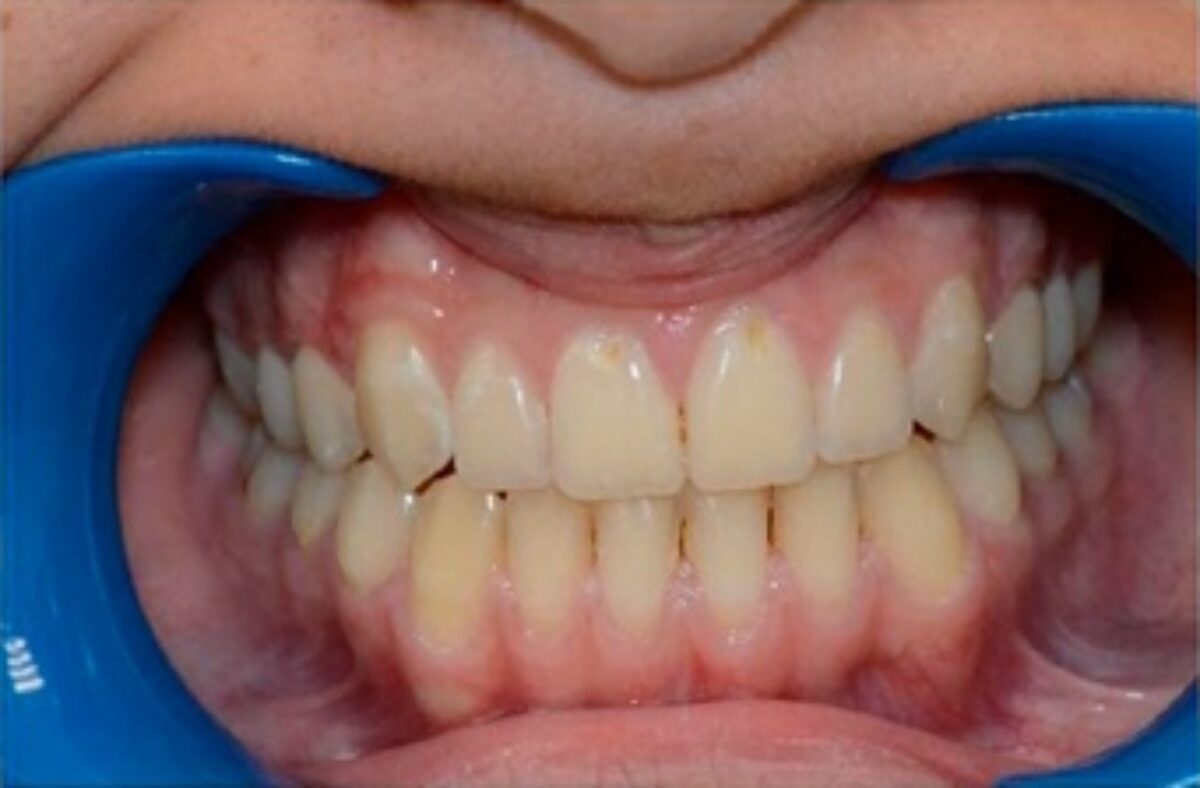 Résultat d'un traitement orthodontique avec des dents parfaitement alignées chez le Dr Wees.