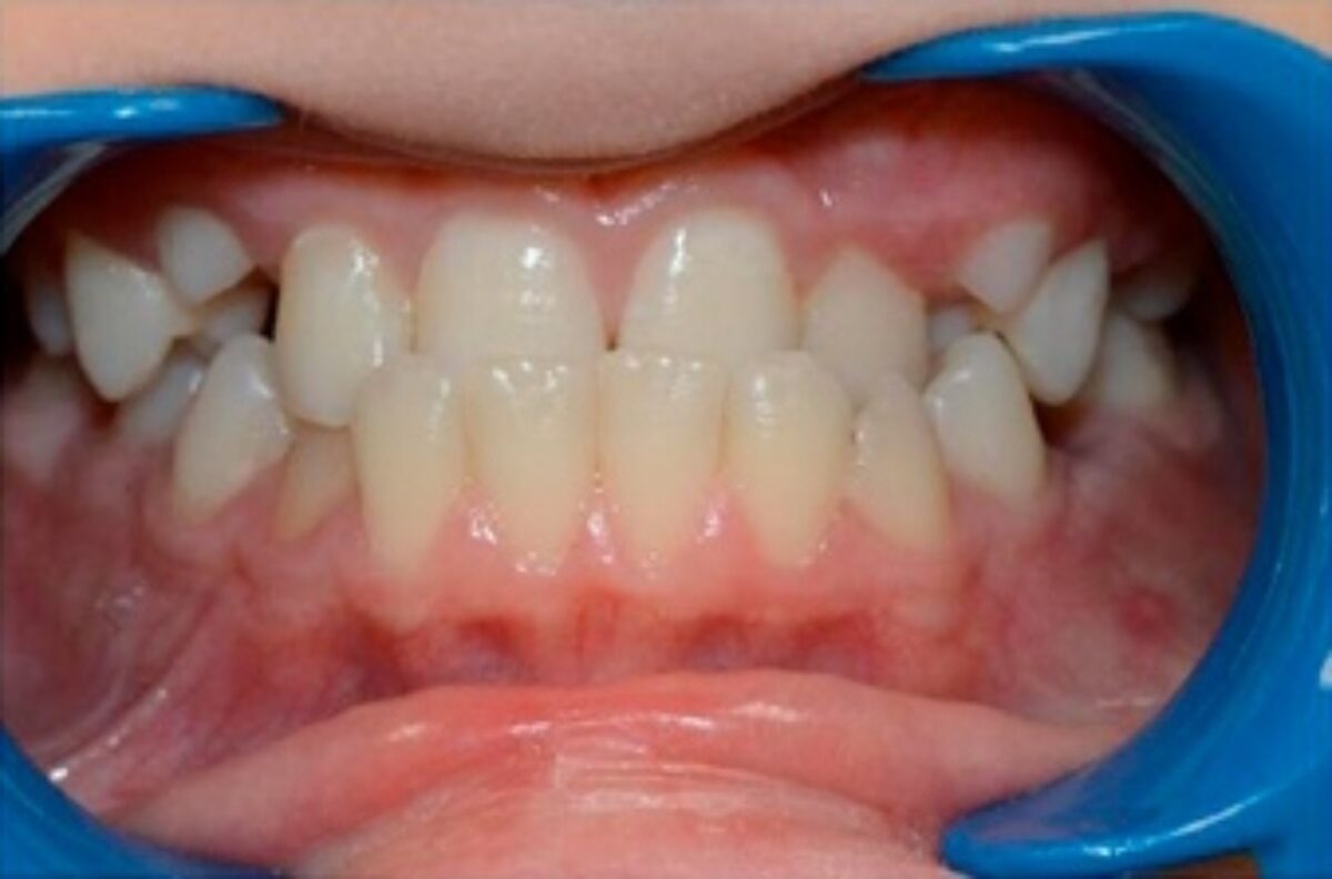 Vue de face de dents d'enfant avant traitement orthodontique à Caen par le Dr Wees