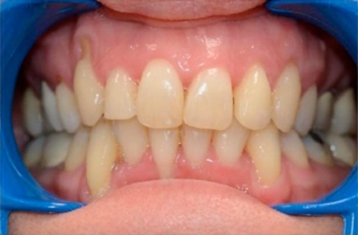 Vue de face des dents d'un patient avant un traitement orthodontique à Caen.