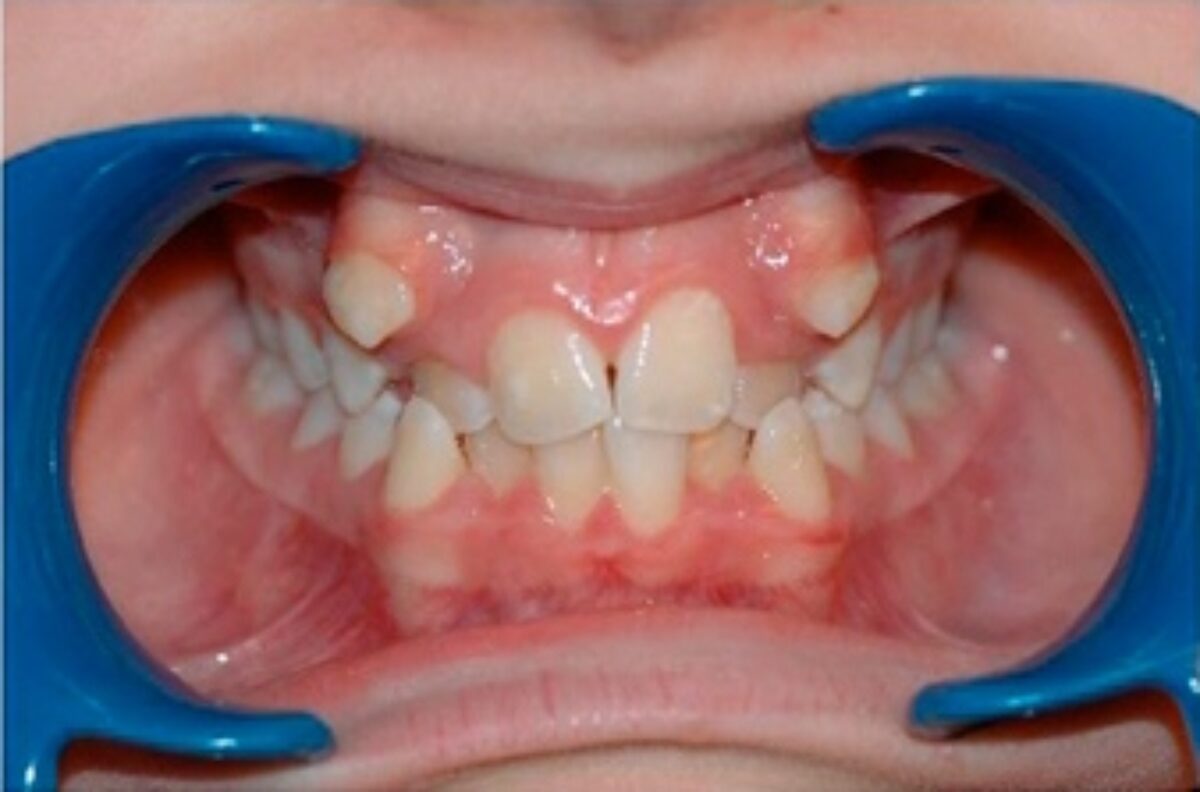 Exemple de malocclusion dentaire nécessitant un traitement orthodontique à Caen.