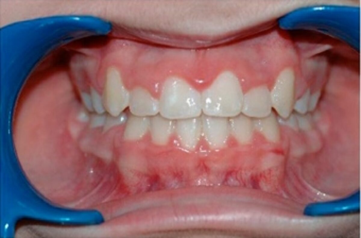 Exemple de malocclusion dentaire observée au cabinet d'orthodontie du Dr Wees à Caen.