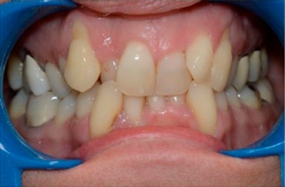 Photographie clinique montrant une malocclusion dentaire avant le traitement orthodontique.