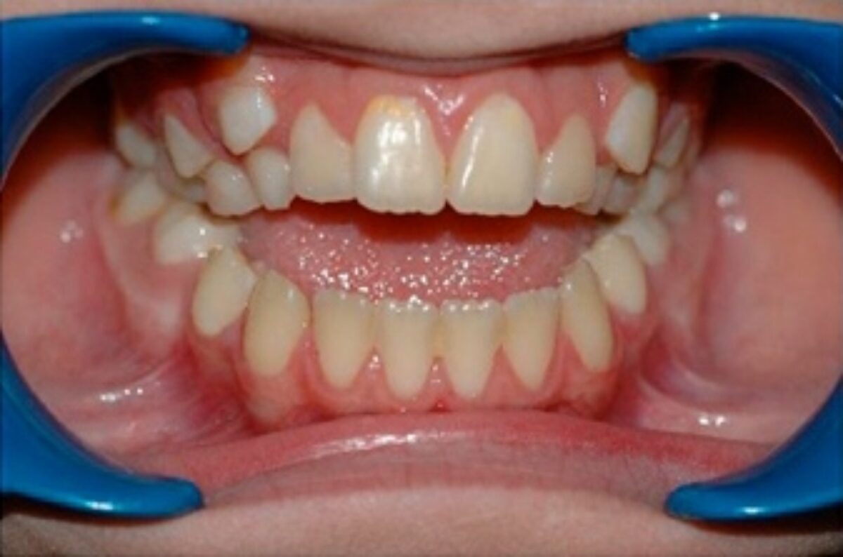Exemple de malocclusion dentaire avant un traitement orthodontique par le Dr Wees à Caen