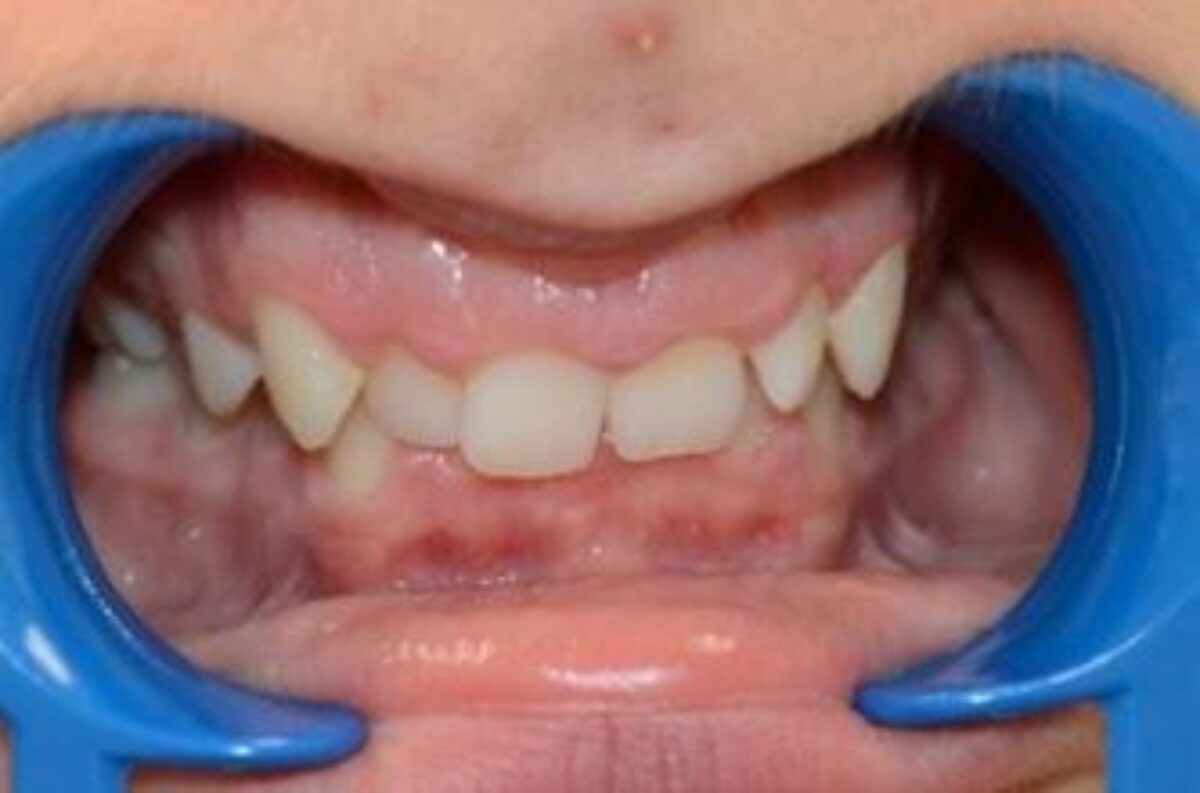 Exemple de malocclusion dentaire avant le traitement orthodontique du Dr Wees à Caen.
