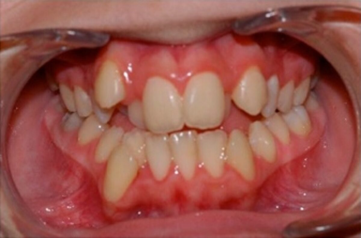 Exemple de malocclusion dentaire avant un traitement orthodontique à Caen par le Dr Wees